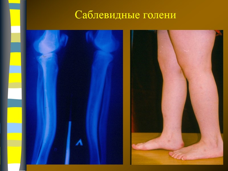 09.12.2017 Саблевидные голени